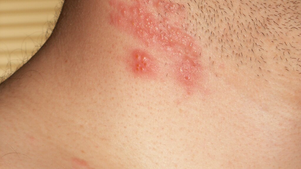 Herpes-zóster: a reativação do vírus da catapora