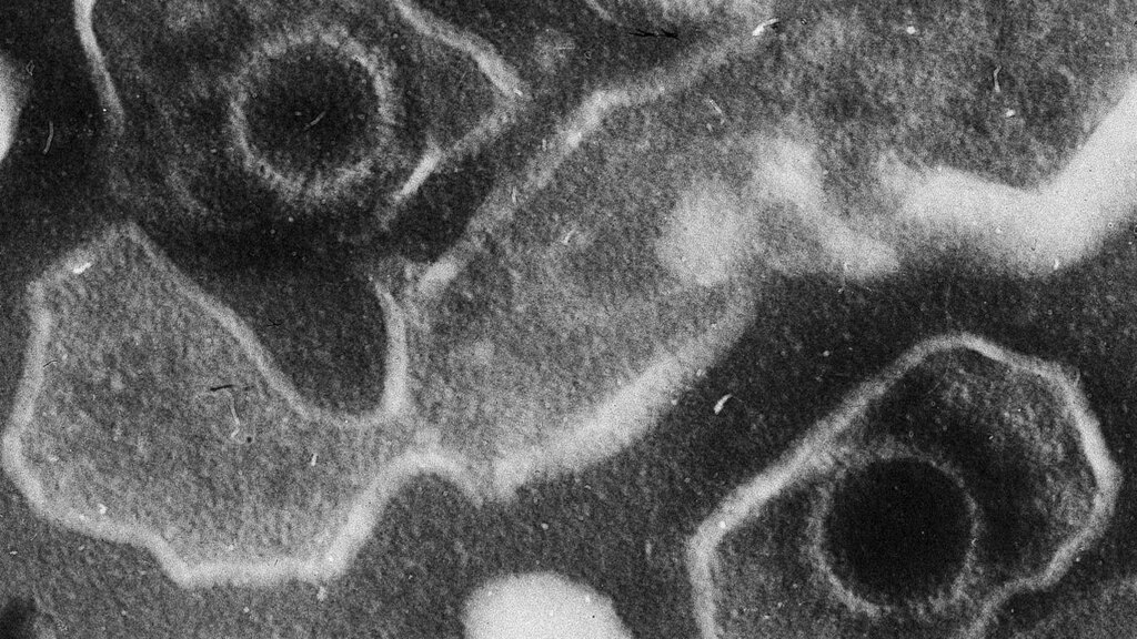 Mononucleose: a doença do beijo explicada