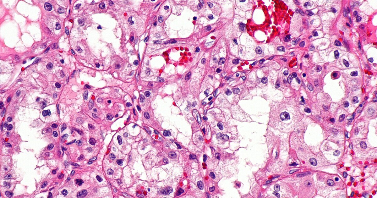 Oncologia de precisão: tratar o câncer pelo perfil genético do tumor