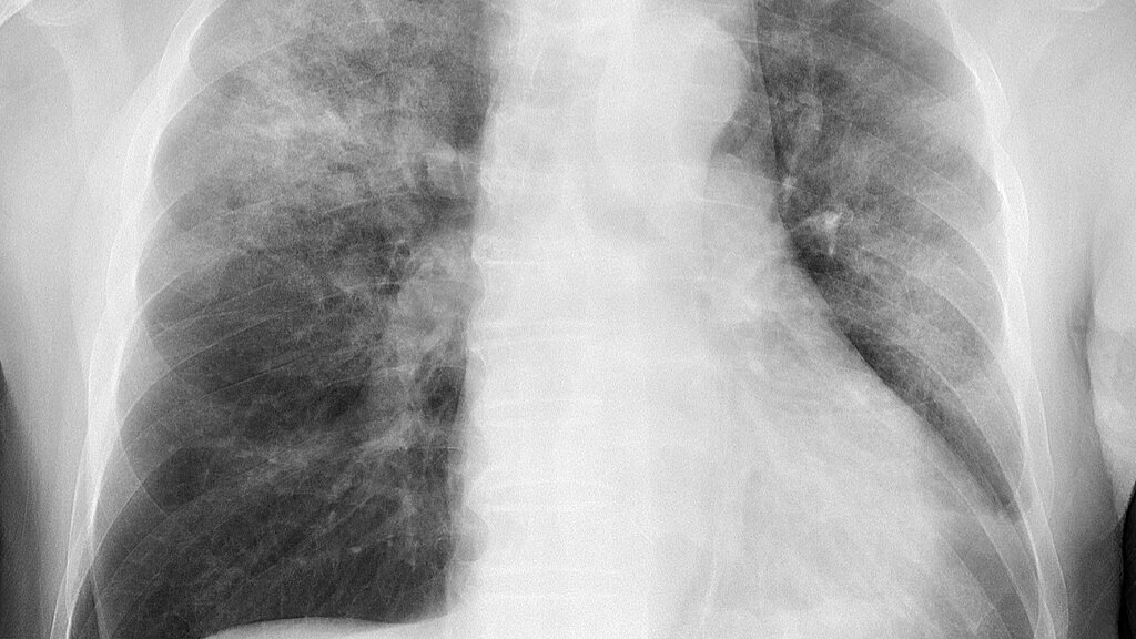 Pneumonia adquirida na comunidade: avaliando a gravidade